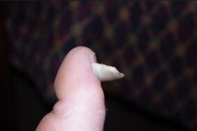 Symptômes de champignon sur les ongles
