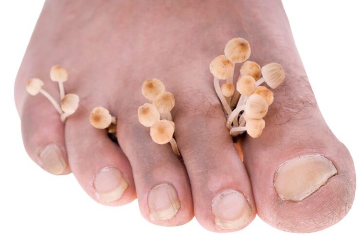 champignon sur les jambes symptômes