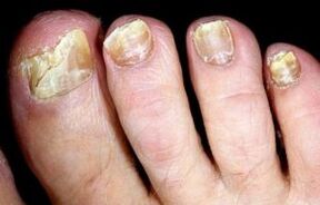 symptômes de la mycose des ongles des pieds